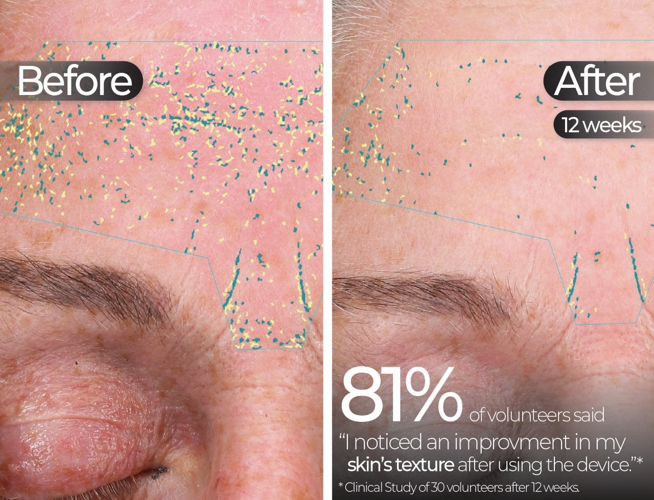 Wavelength Pro 5-in-1 LED Mask